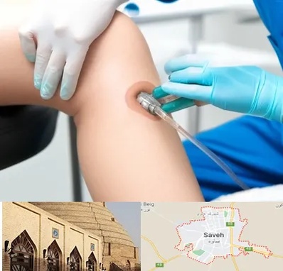 اوزون تراپی در ساوه