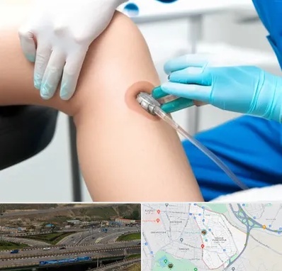 اوزون تراپی در یاغچیان تبریز 