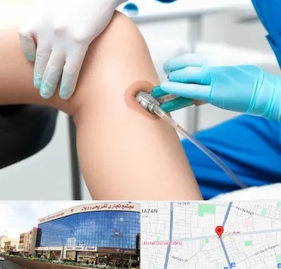 اوزون تراپی در نصف راه تبریز 