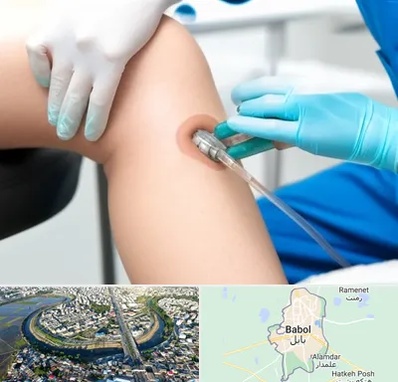 اوزون تراپی در بابل