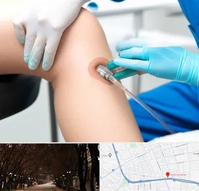 اوزون تراپی در ابوریحان تبریز 