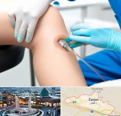 اوزون تراپی در زنجان