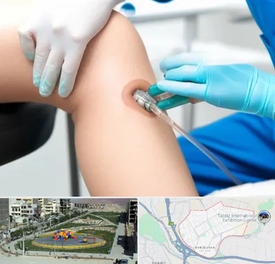 اوزون تراپی در مرزداران تبریز 