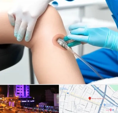 اوزون تراپی در آبرسان تبریز 