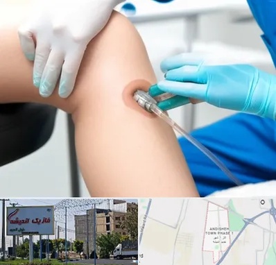 اوزون تراپی در فاز یک اندیشه