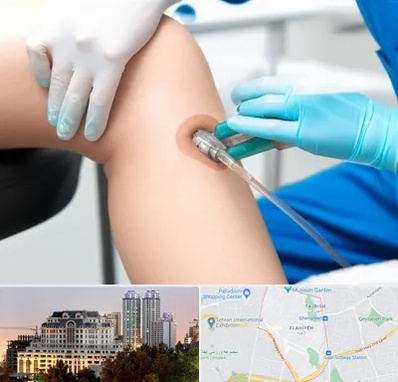 اوزون تراپی در فرشته 