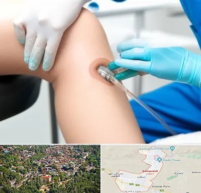 اوزون تراپی در دماوند