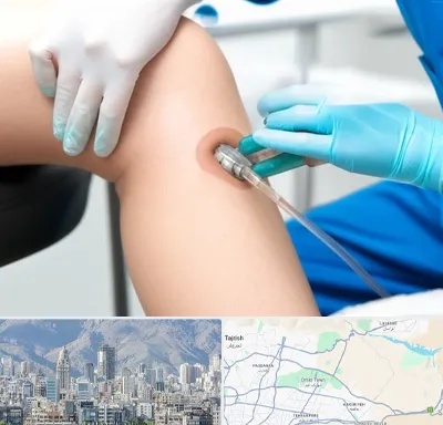 اوزون تراپی در شمال شرق تهران
