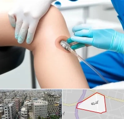 اوزون تراپی در آذری