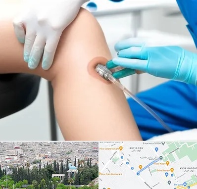 اوزون تراپی در محلاتی شیراز 