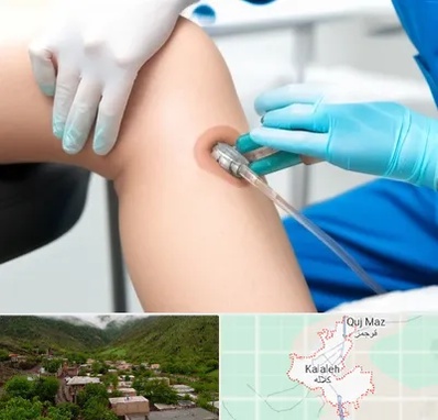 اوزون تراپی در کلاله