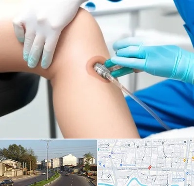 اوزون تراپی در ضیابری رشت 