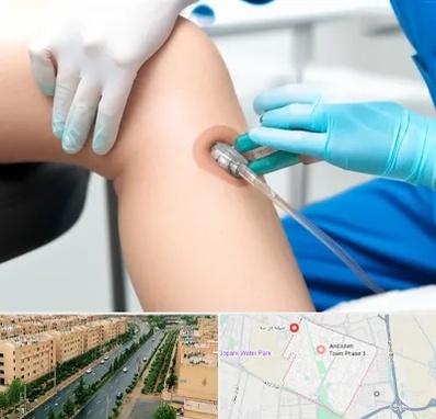 اوزون تراپی در فاز سه اندیشه