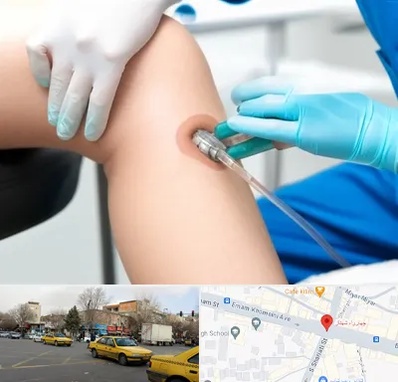 اوزون تراپی در شهناز تبریز 