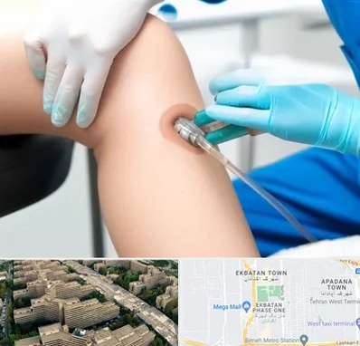 اوزون تراپی در اکباتان 