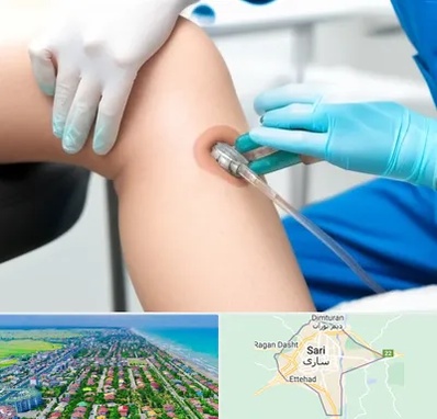 اوزون تراپی در ساری