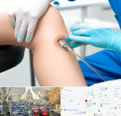 اوزون تراپی در خیابان آزادی 