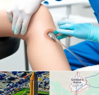 اوزون تراپی در گنبد کاووس