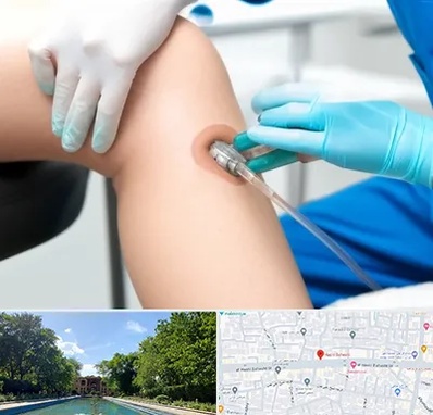 اوزون تراپی در هشت بهشت اصفهان 