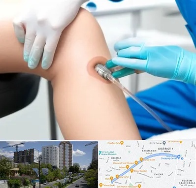 اوزون تراپی در اندرزگو 