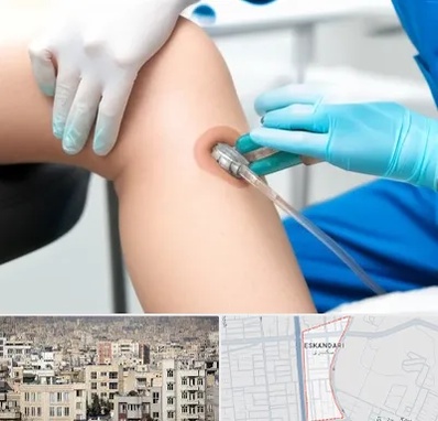 اوزون تراپی در اسکندری 