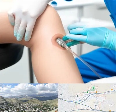 اوزون تراپی در رودهن