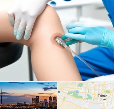 اوزون تراپی در غرب تهران 