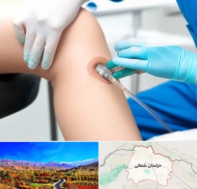 اوزون تراپی در خراسان شمالی