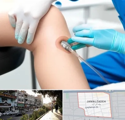 اوزون تراپی در خیابان جمالزاده