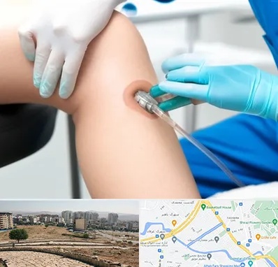 اوزون تراپی در کوی وحدت شیراز 