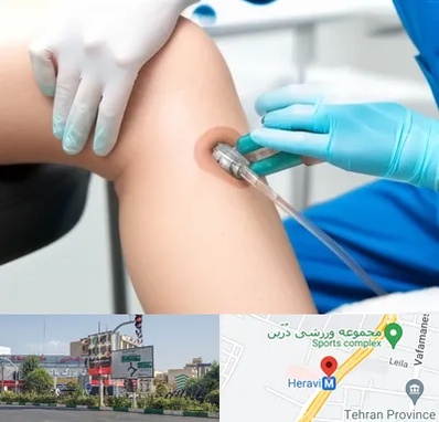 اوزون تراپی در هروی