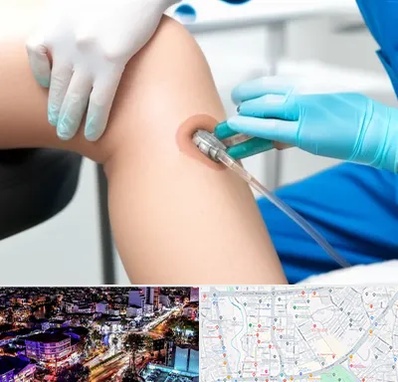 اوزون تراپی در منظریه رشت 