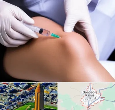 پلاسما درمانی PRP در گنبد کاووس