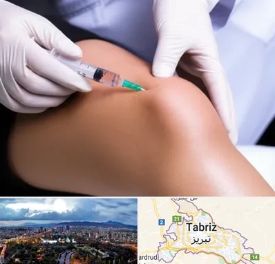 پلاسما درمانی PRP در تبریز