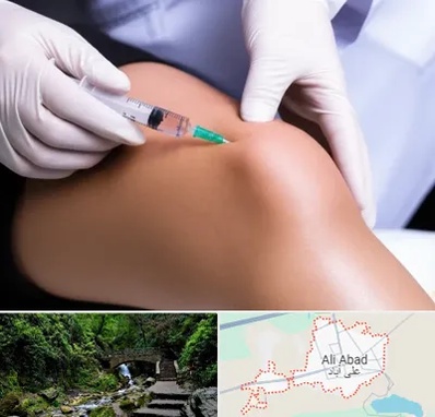 پلاسما درمانی PRP در علی آباد کتول