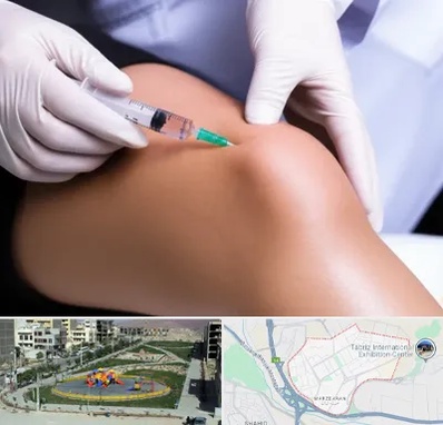 پلاسما درمانی PRP در مرزداران تبریز 