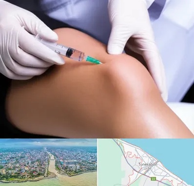 پلاسما درمانی PRP در تنکابن