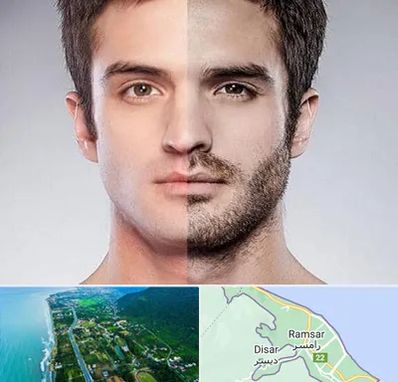 کاشت ریش و سبیل در رامسر