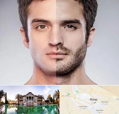 کاشت ریش و سبیل در شیراز