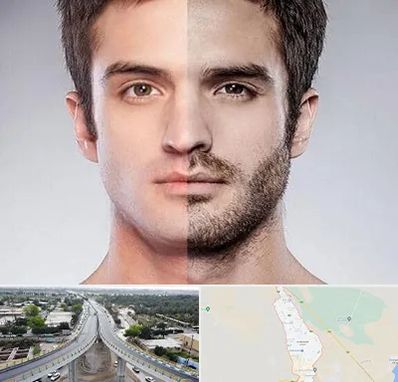 کاشت ریش و سبیل در اندیمشک