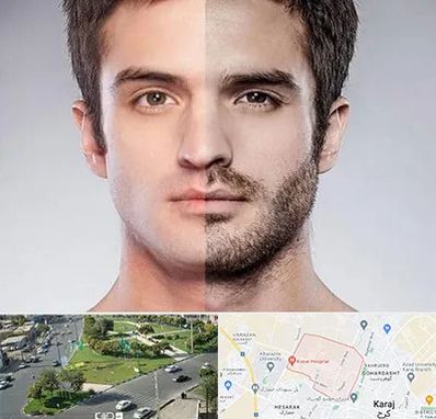 کاشت ریش و سبیل در شاهین ویلا کرج