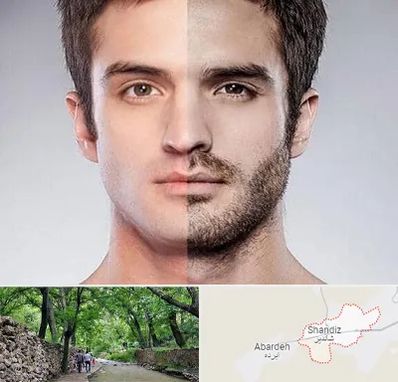 کاشت ریش و سبیل در شاندیز مشهد