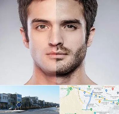 کاشت ریش و سبیل در شریعتی مشهد