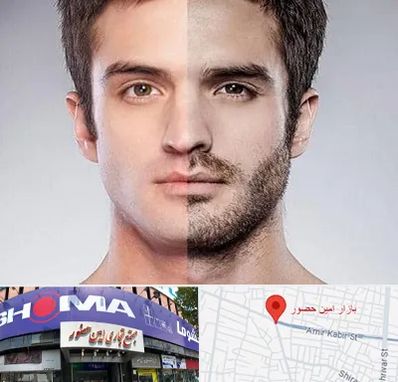 کاشت ریش و سبیل در امین حضور