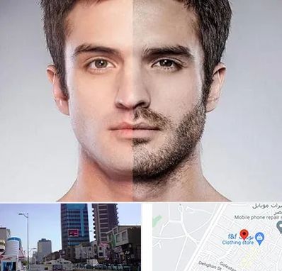 کاشت ریش و سبیل در چهارراه طالقانی کرج