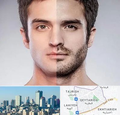 کاشت ریش و سبیل در قیطریه