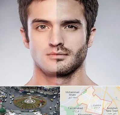 کاشت ریش و سبیل در فردیس کرج