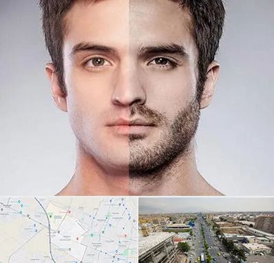 کاشت ریش و سبیل در حصارک کرج