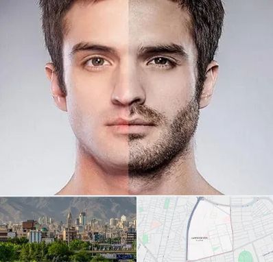 کاشت ریش و سبیل در جمشیدیه