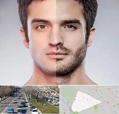 کاشت ریش و سبیل در احمدآباد مشهد